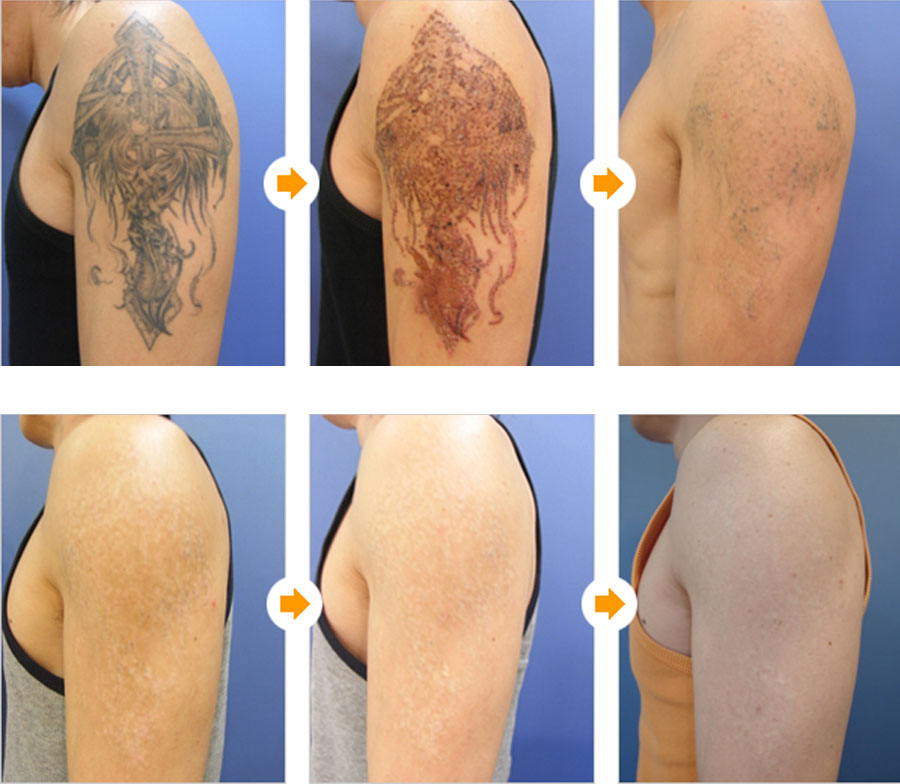 Charisma ihr Experte für Tattooentfernung in der Region Lindau